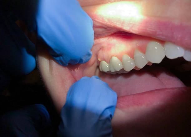 Best Emergency Wisdom Tooth Extraction in Perry, MI
